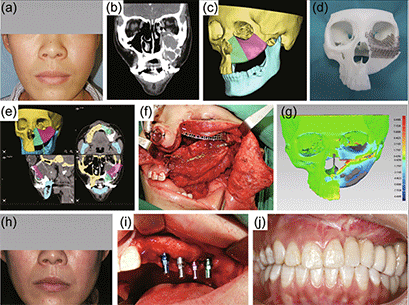 Review paper on Computer-assisted Surgery in Oral and Maxillofacial Oncology Published by Guang-Yan Yu and Xin Peng’s Research Group of PKUSS
